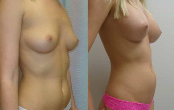 breast-augmentation-paciente-1-2-1024x741