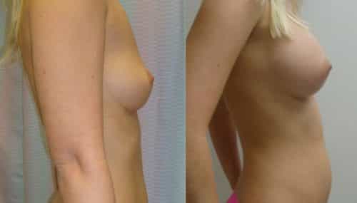 breast-augmentation-paciente-1-3-1024x740