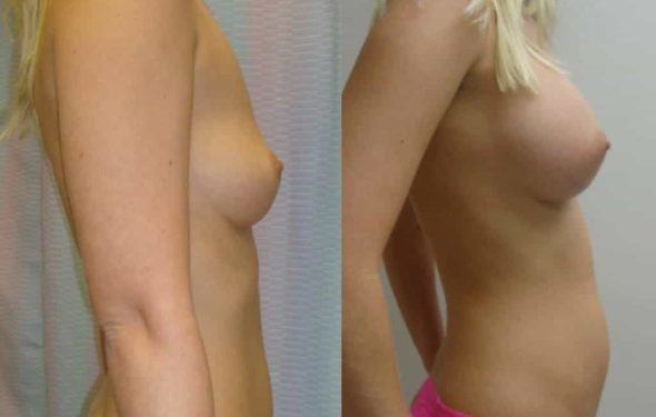 breast-augmentation-paciente-1-3-1024x740