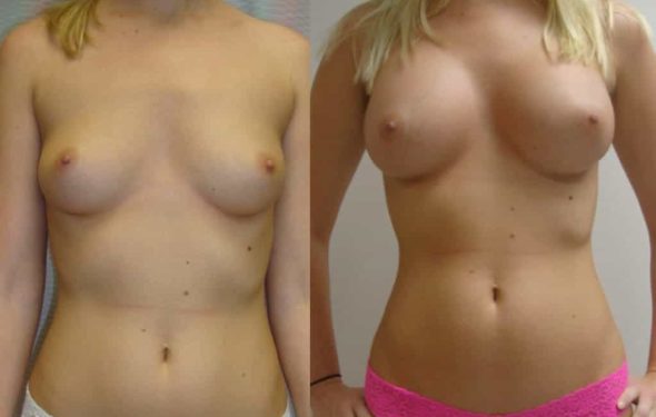 breast-augmentation-paciente-1