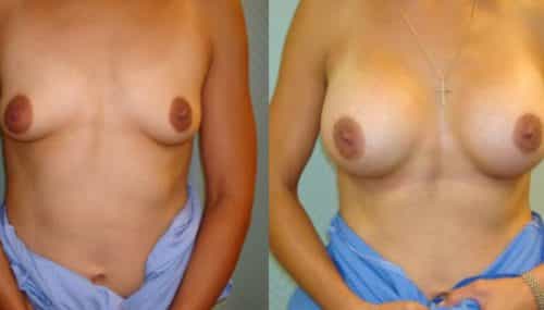 breast-augmentation-paciente-2-1-800x400 - copia