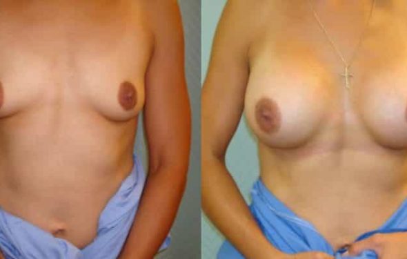 breast-augmentation-paciente-2-1-800x400 - copia
