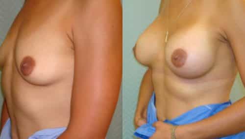 breast-augmentation-paciente-2-2-800x400 - copia