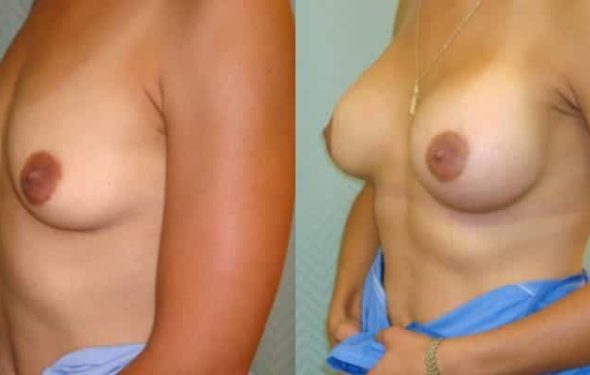breast-augmentation-paciente-2-2-800x400 - copia