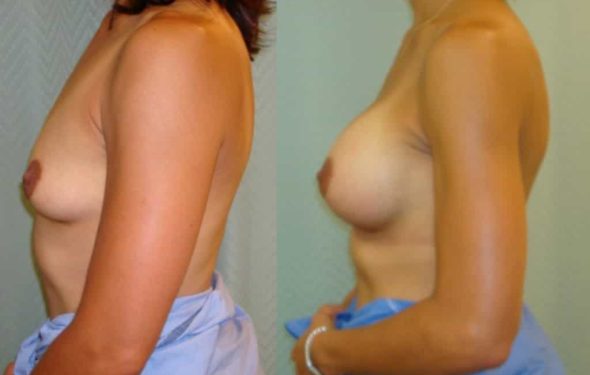 breast-augmentation-paciente-2-3-1024x737