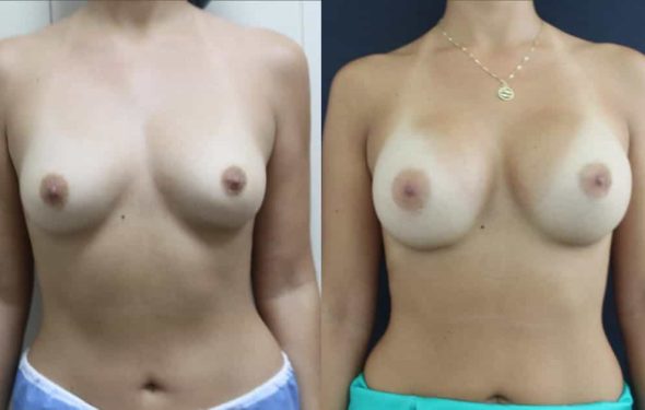 breast-augmentation-paciente-3-1-1024x629