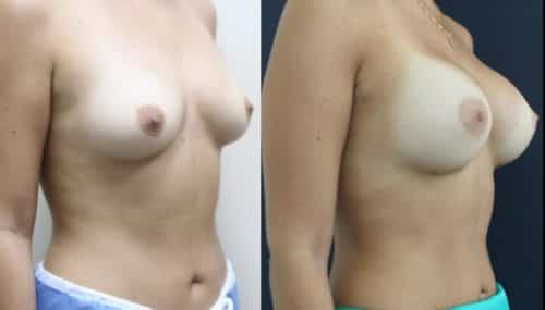 breast-augmentation-paciente-3-2-1024x708