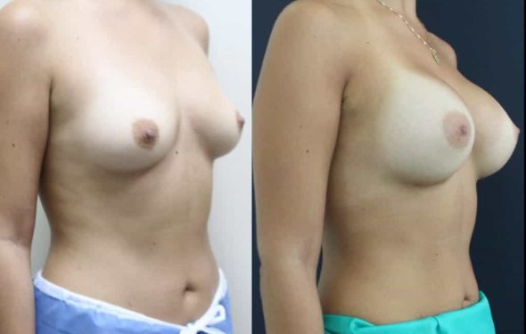 breast-augmentation-paciente-3-2-1024x708