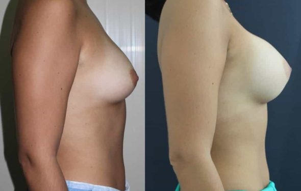 breast-augmentation-paciente-3-3-1024x741