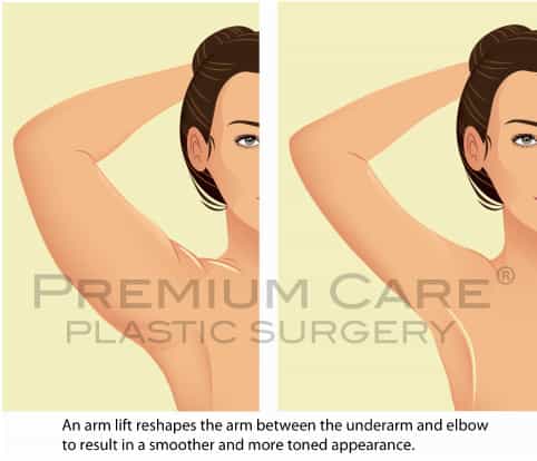 Arm lift Colombia - Premium Care Plastic Surgery