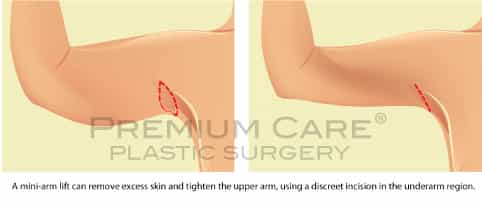 Arm lift Colombia - Premium Care Plastic Surgery