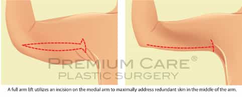 Arm Lift Colombia  Premium Care Plastic Surgery