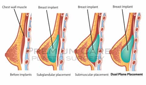 Breast Augmentation in Colombia