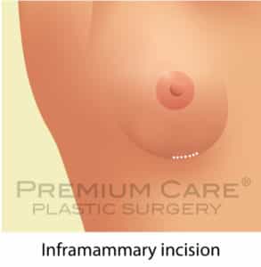 Breast Augmentation in Colombia