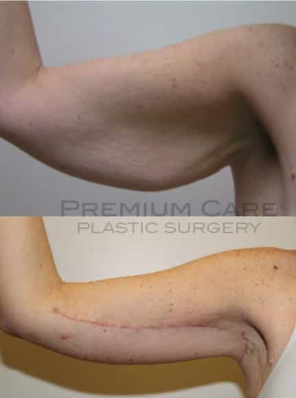 Arm lift Colombia - Premium Care Plastic Surgery