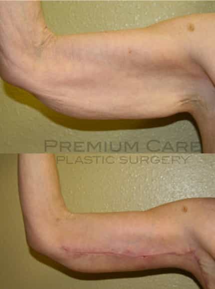 Arm lift Colombia - Premium Care Plastic Surgery