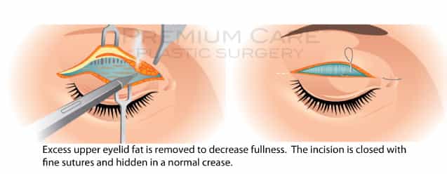 Eyelid Surgery in Colombia