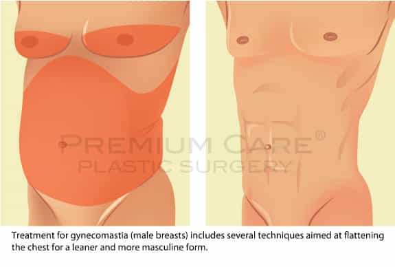 Male breast reduction Colombia - Premium Care Plastic Surgery