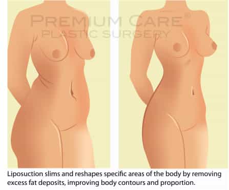 Liposuction in Colombia - Premium Care Plastic Surgery
