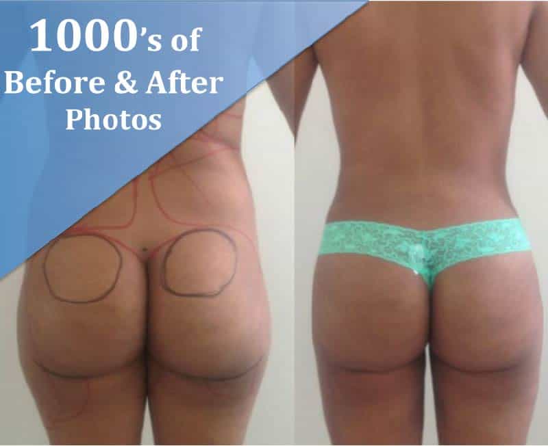 Before and After - Plastic Surgery Colombia
