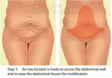 Tummy Tuck in Los Altos  What is Abdominoplasty?