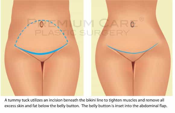 Sure signs of infection after a tummy tuck - Hourglass Tummy Tuck