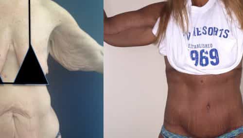 Before and After Arm Lift Colombia - Premium Care Plastic Surgery