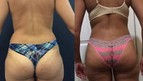 Before and After brazilian butt lift Colombia - Premium Care Plastic Surgery