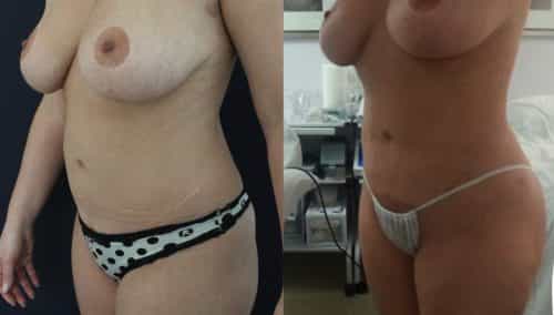 Brazilian Butt Lift Cartagena Colombia - Premium Care Plastic Surgery