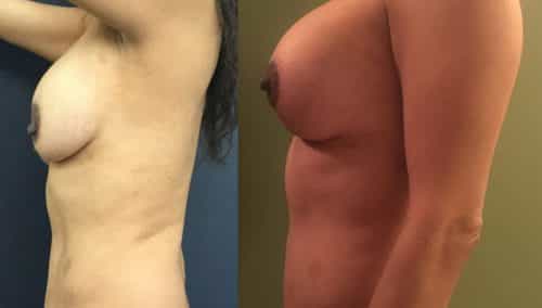 Before and after Breast Revision Colombia - Premium Care Plastic Surgery