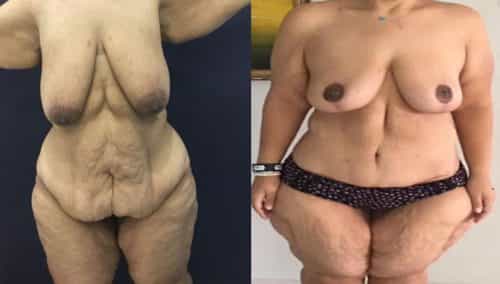 Breast LBreast Lift Colombia - Premium Care Plastic Surgeryift Cartagena Colombia - Premium Care Plastic Surgery