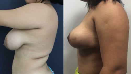 Breast Lift Cartagena Colombia - Premium Care Plastic Surgery