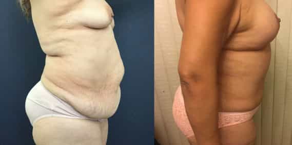 Breast Lift with Implants Colombia - Premium Care Plastic Surgery
