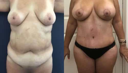 Breast Lift with Implants Colombia -Premium Care Plastic Surgery