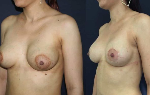 Before and after Breast Revision Colombia - Premium Care Plastic Surgery Before and after Breast Revision Colombia - Premium Care Plastic Surgery