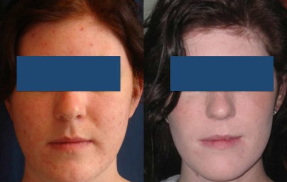 Before and After Buccal Fat Removal Colombia - Premium Care Plastic Surgery