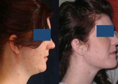 Before and After Buccal Fat Removal Colombia - Premium Care Plastic Surgery