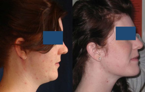 Before and After Buccal Fat Removal Colombia - Premium Care Plastic Surgery