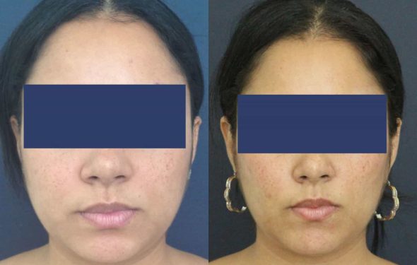 Before and After Buccal Fat Removal Colombia - Premium Care Plastic Surgery