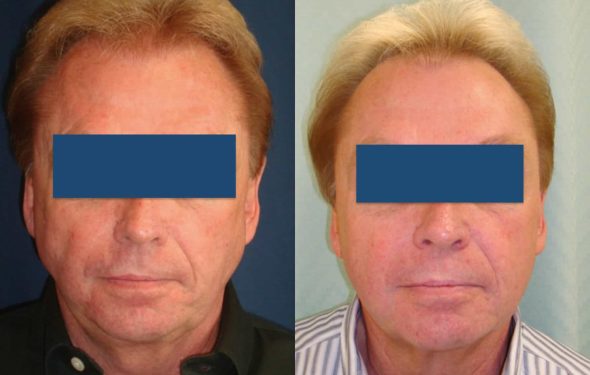 Facelift Colombia - Premium Care Plastic Surgery