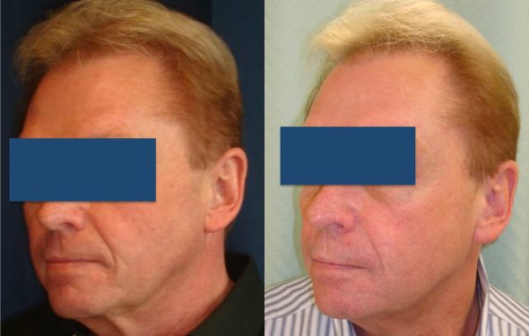 Facelift Colombia - Premium Care Plastic Surgery