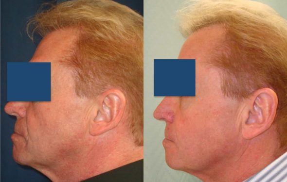 Facelift Colombia - Premium Care Plastic Surgery