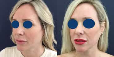 Facial Fat Grafting Colombia - Premium Care Plastic Surgery