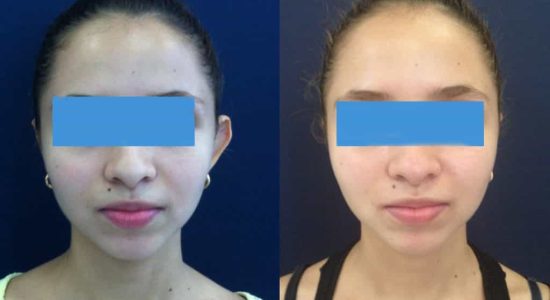 Ear Surgery Colombia - Premium Care Plastic Surgery