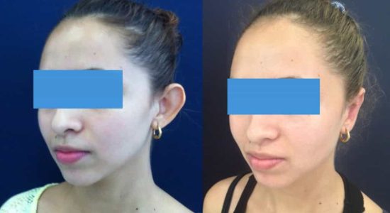 Ear Surgery Colombia - Premium Care Plastic Surgery
