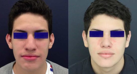 Ear Surgery Colombia - Premium Care Plastic Surgery