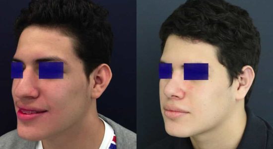 Ear Surgery Colombia - Premium Care Plastic Surgery