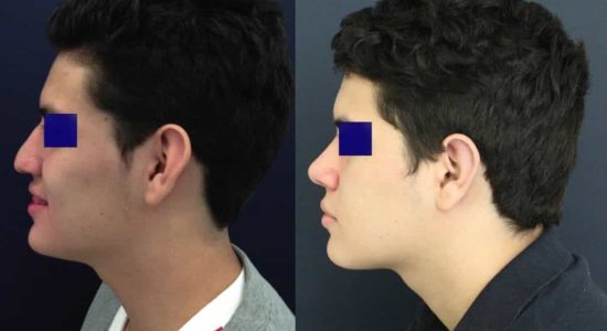 Ear Surgery Colombia - Premium Care Plastic Surgery
