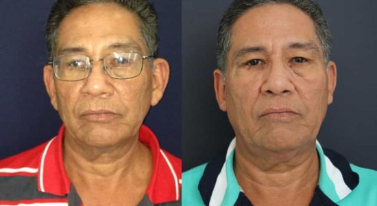 Ear Surgery Colombia - Premium Care Plastic Surgery