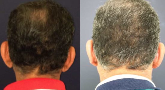 Ear Surgery Colombia - Premium Care Plastic Surgery